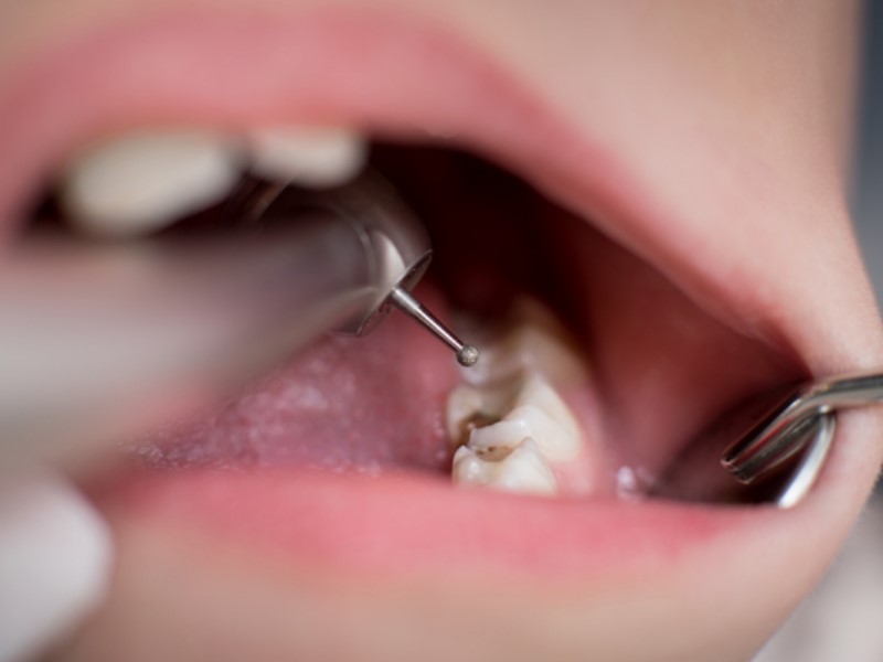 Preprečite karies preden se razvije v težjo obliko zobne gnilobe.